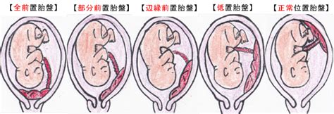 低位胎盤改善